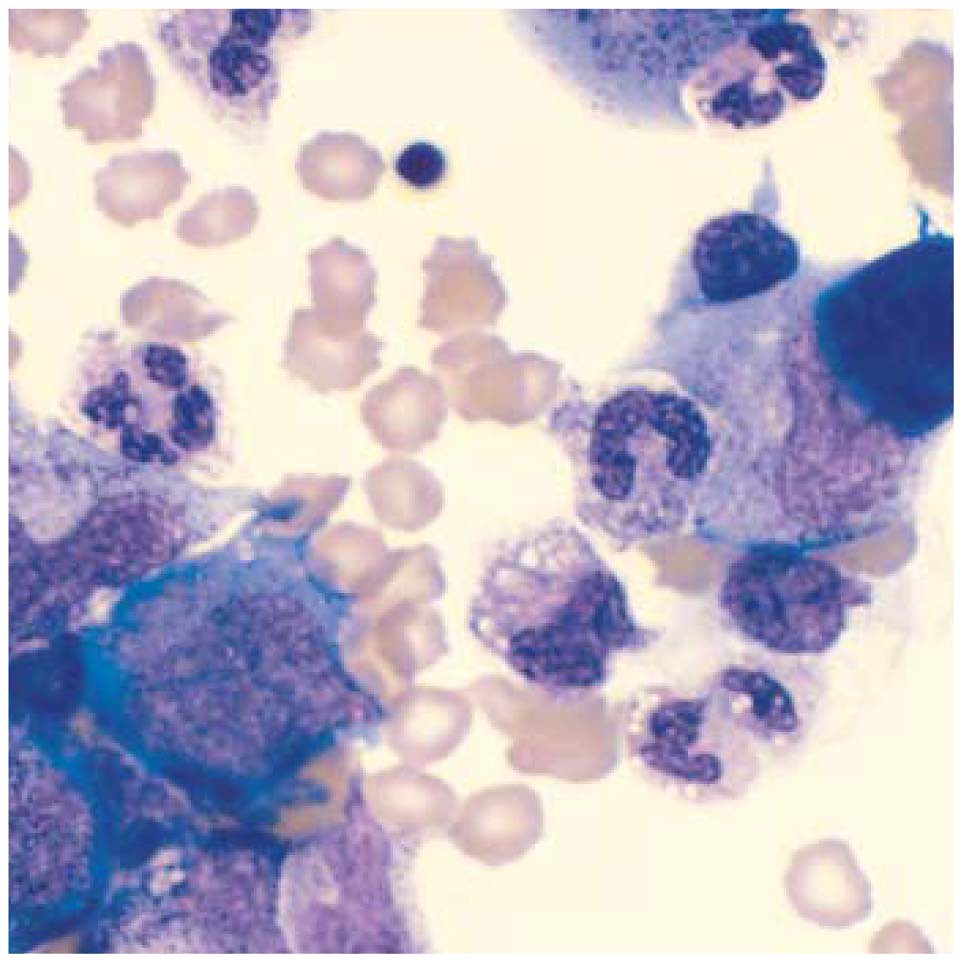 Blood Test for Alzheimer’s: Proven Breakthrough in Indore